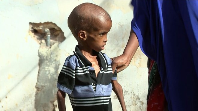 Malnutrition, particularly in children and the elderly, is clear to see. Credit: ITV News